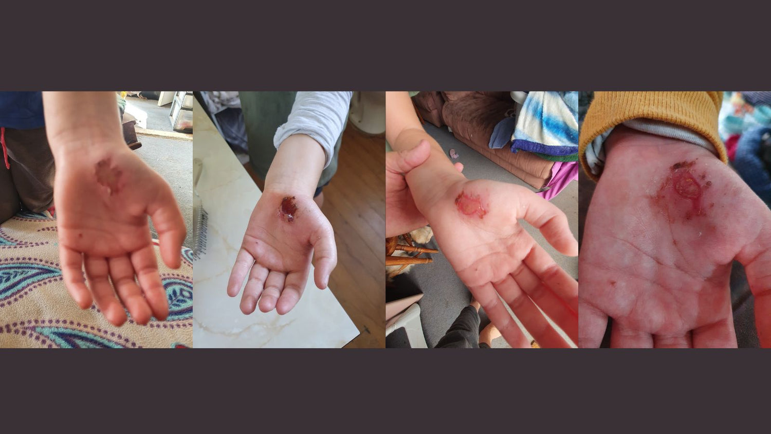 Progress of healing on Wound on Childs Hand